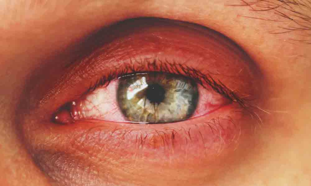Blepharitis Treatments