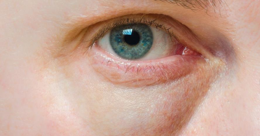 Eyelid Puffiness