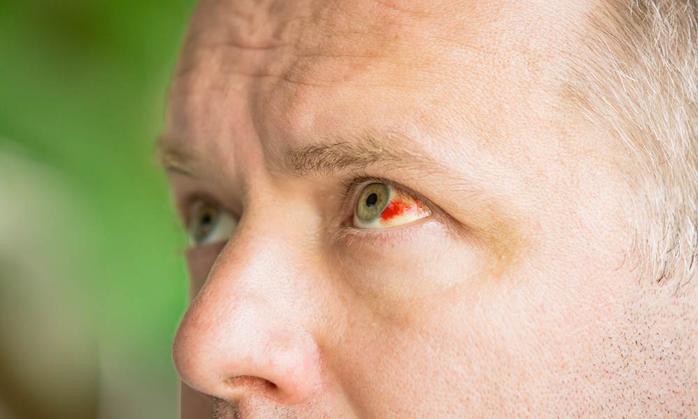 My Eye Is Bloody Red!